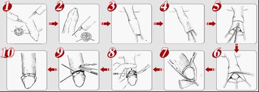 包皮手术过程